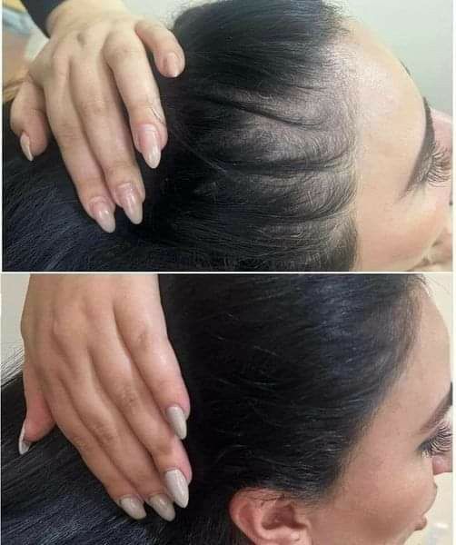 Électrothérapie haute fréquence AltheaFrequency™