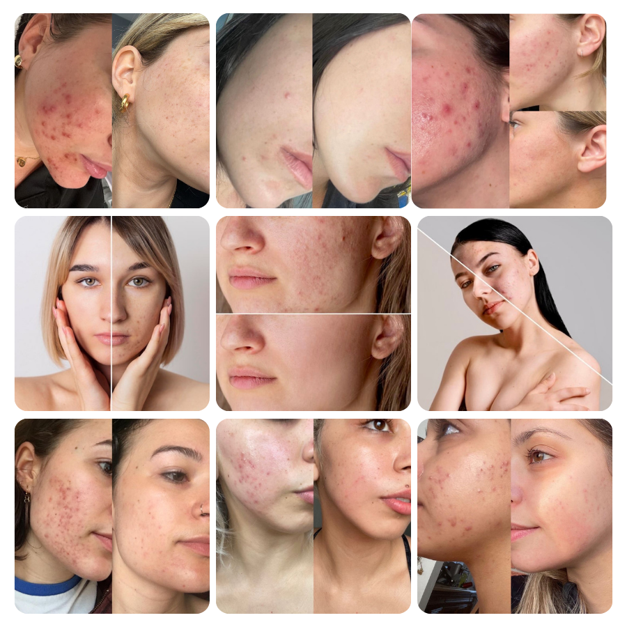 Électrothérapie haute fréquence AltheaFrequency™