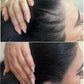Électrothérapie haute fréquence AltheaFrequency™