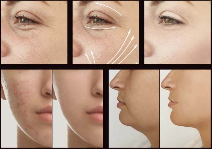 Électrothérapie haute fréquence AltheaFrequency™
